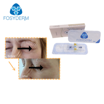 Fosyderm-Kreuz verband Feinlinienhyaluronsäure ha-Füller-2ml für Augen-Falten